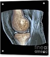 Knee Injury, 3d Ct Scan #1 Acrylic Print