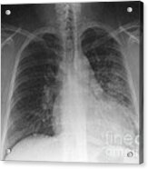 Pneumonia, X Ray #1 Acrylic Print