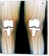 Bilateral Total Knee Replacement Acrylic Print