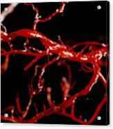 Blocked Coronary Arteries Acrylic Print