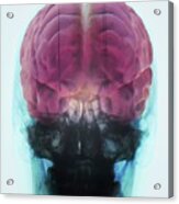 Brain Implants For Parkinson's Disease Acrylic Print