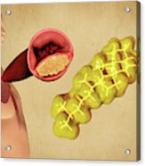 Cholesterol And Atherosclerosis, Artwork Acrylic Print