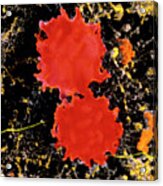Colour Sem Of Echinocytes (blood) In Gastric Ulcer Acrylic Print