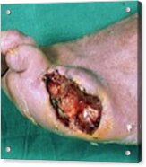 Gangrenous Foot Ulcer Acrylic Print