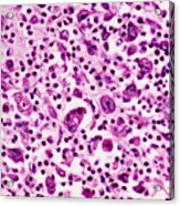 Giant-cell Carcinoma Of The Lung, Lm Acrylic Print