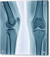 Healthy Knee, X-ray Acrylic Print