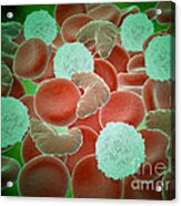 Sickle Cell Anemia With Red Blood Cells Acrylic Print