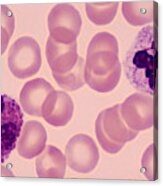 Two White Blood Cells Or Leukocytes--neutrophil (right) And Eosinophil (left), Human Blood Smear, 500x Acrylic Print