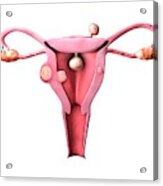 Uterine Fibroids Acrylic Print