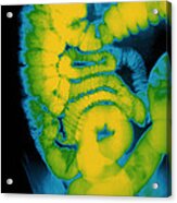 X-ray Of Large Intestine Acrylic Print