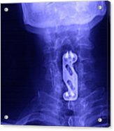 X-ray Of Neck Implant #1 Acrylic Print