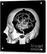 3d Image Of Skull And Brain Avm #2 Acrylic Print