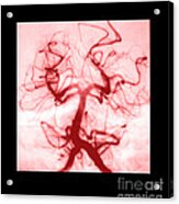 Angiogram Of Embolus In Cerebral Artery Acrylic Print