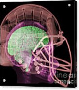 X-ray Of Head In Football Helmet #2 Acrylic Print