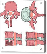 Illustration Of Spinal Disk Pathologies #4 Acrylic Print