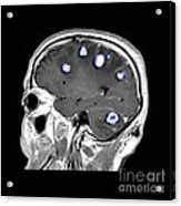 Brain Tumors #5 Acrylic Print