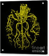 Intracranial Ct Angiogram #5 Acrylic Print