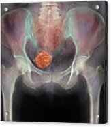 Uterine Fibroid #5 Acrylic Print