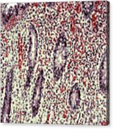 Appendicitis, Light Micrograph Acrylic Print