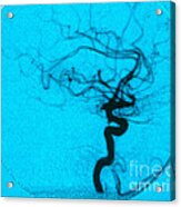 Cerebral Angiogram Acrylic Print