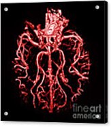 Intracranial Ct Angiogram Acrylic Print