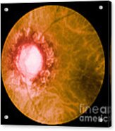 Retina Infected By Syphilis Acrylic Print