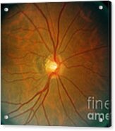 Retina, Lupus Patient Acrylic Print