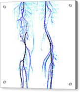 Atherosclerosis, Ct Angiogram #2 Acrylic Print