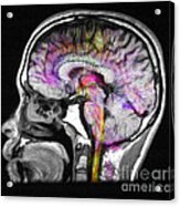 Normal Brain, Fiber Tractography And Mri #3 Acrylic Print