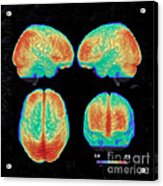Bipolar Brain, 3d Mri Scan Acrylic Print