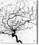 Dural Arterial Venous Fistula, Angiogram Acrylic Print