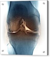 Osteoarthritis Of The Knee Joint #1 Acrylic Print