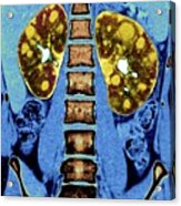 Polycystic Kidneys #7 Acrylic Print