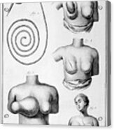 Breast Surgery, 1751-1777 Acrylic Print