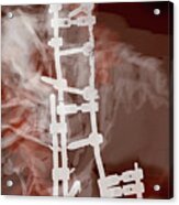 Spinal Prosthesis, Study 7 Acrylic Print