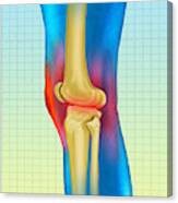 Knee Arthritis #1 Canvas Print