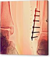 Pinned Ankle Fractures #1 Canvas Print