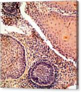Anal Squamous Cell Carcinoma, Lm #2 Canvas Print