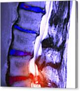 Arthritic Spine #2 Canvas Print
