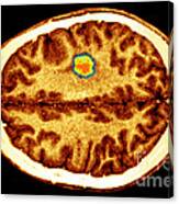 Glioma Brain Tumor #2 Canvas Print