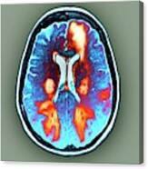 Brain In Toxic Encephalopathy #4 Canvas Print