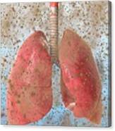 Allergen-related Asthma Canvas Print