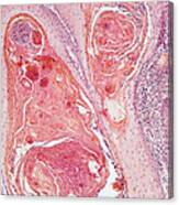Anal Squamous Cell Carcinoma, Lm Canvas Print