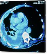 Mesothelioma Lung Cancer Canvas Print