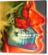 Orthodontic Brace X-ray Canvas Print