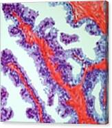 Prostate Cancer, Light Micrograph Canvas Print