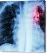 Pulmonary Tuberculosis Canvas Print