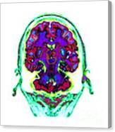 Spect Exam Of Human Brain Canvas Print