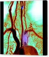 Aortic Arch Angiogram #1 Canvas Print