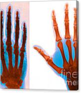 Early And Modern Hand X-rays #4 Canvas Print